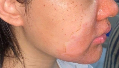 Peel da mặt làm đẹp, cô gái mọc chi chít mụn nước, vỡ chảy dịch