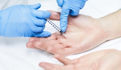 Tiêm botulinum toxin trong điều trị tăng tiết mồ hôi lòng bàn tay