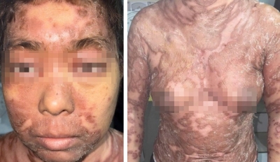 Trường hợp ca bệnh nặng, hiếm gặp - Hội chứng TAMA  (Thymoma-Associated Multiorgan Autoimmunity)