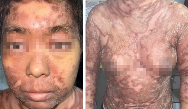 Trường hợp ca bệnh nặng, hiếm gặp - Hội chứng TAMA  (Thymoma-Associated Multiorgan Autoimmunity)